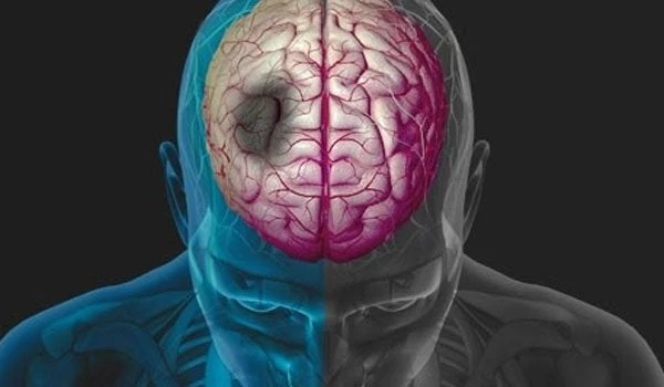 Όγκος στο κεφάλι: Τ συμπτώματα και οι κινήσεις που πρέπει να κάνεις – Μην πανικοβάλλεσαι  μπορεί να μην είναι σοβαρό